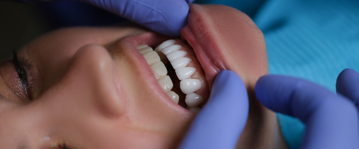 before and after all-on-4 dental implants smile transformation