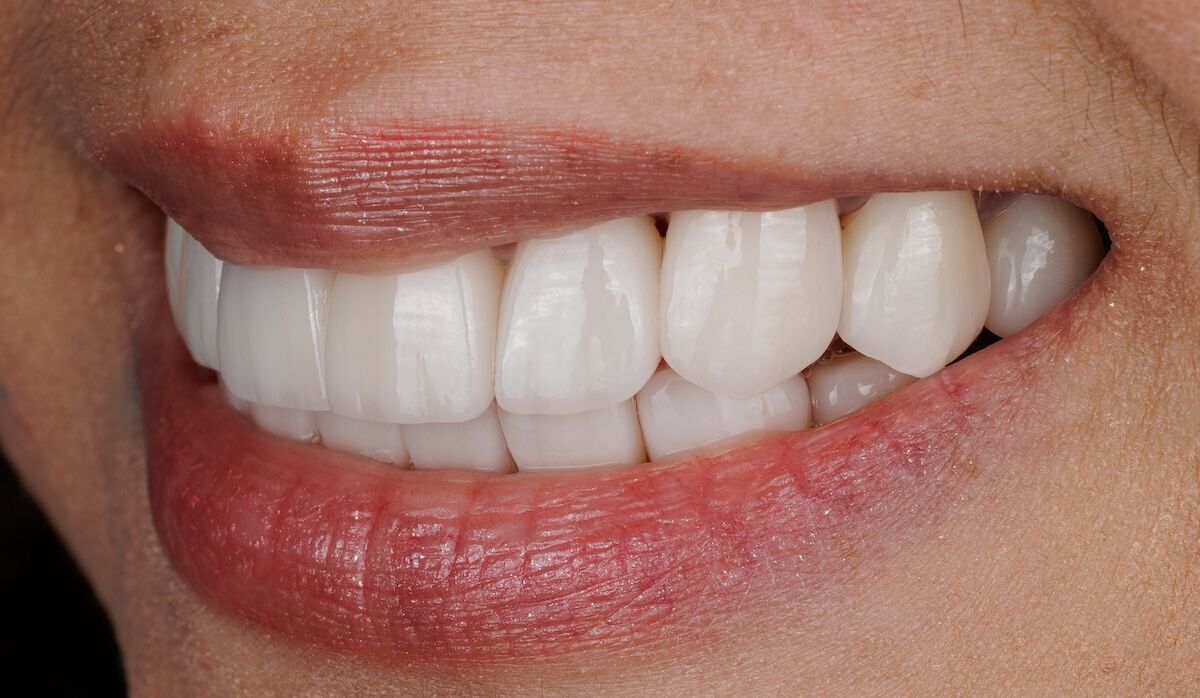 dentist placing titanium dental implant in jawbone