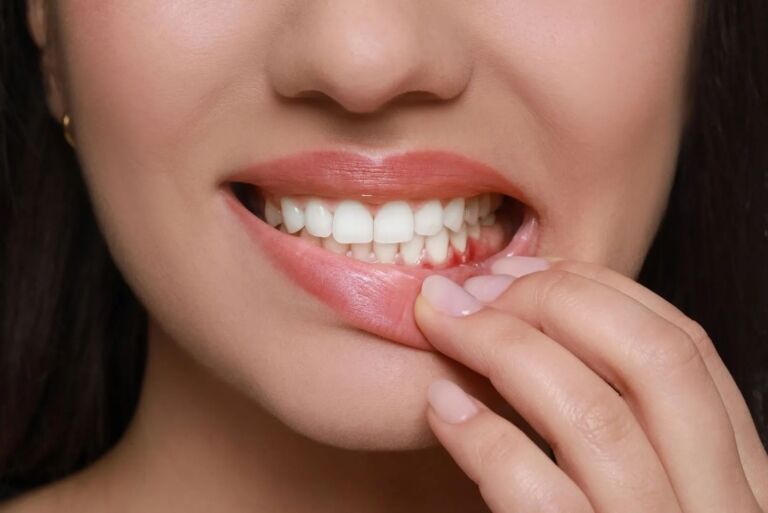 Gum Disease 1 cocodental modern dental clinic providing professional care in uk