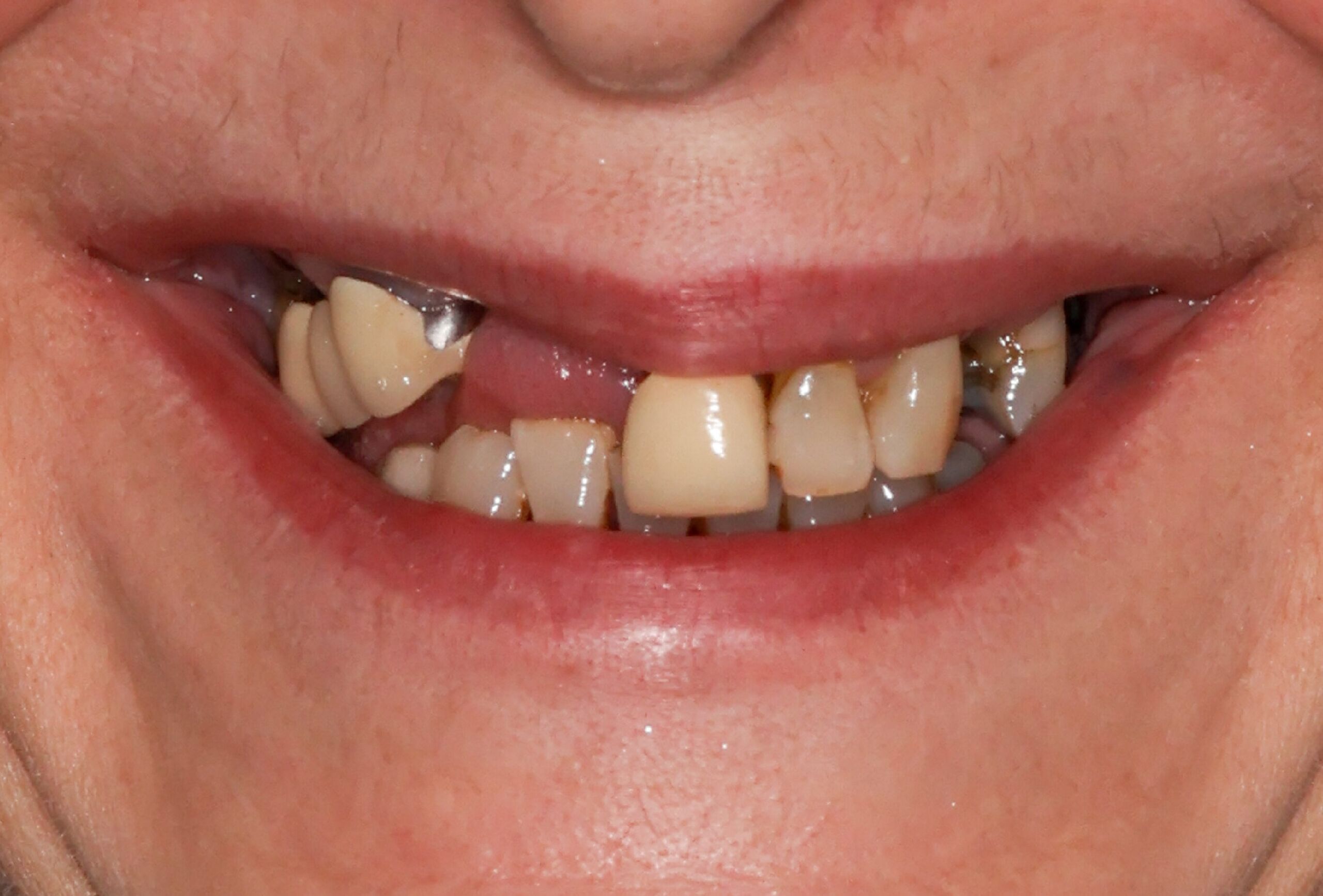 Smile Gallery 392 e1746650472106 cocodental modern dental clinic providing professional care in uk