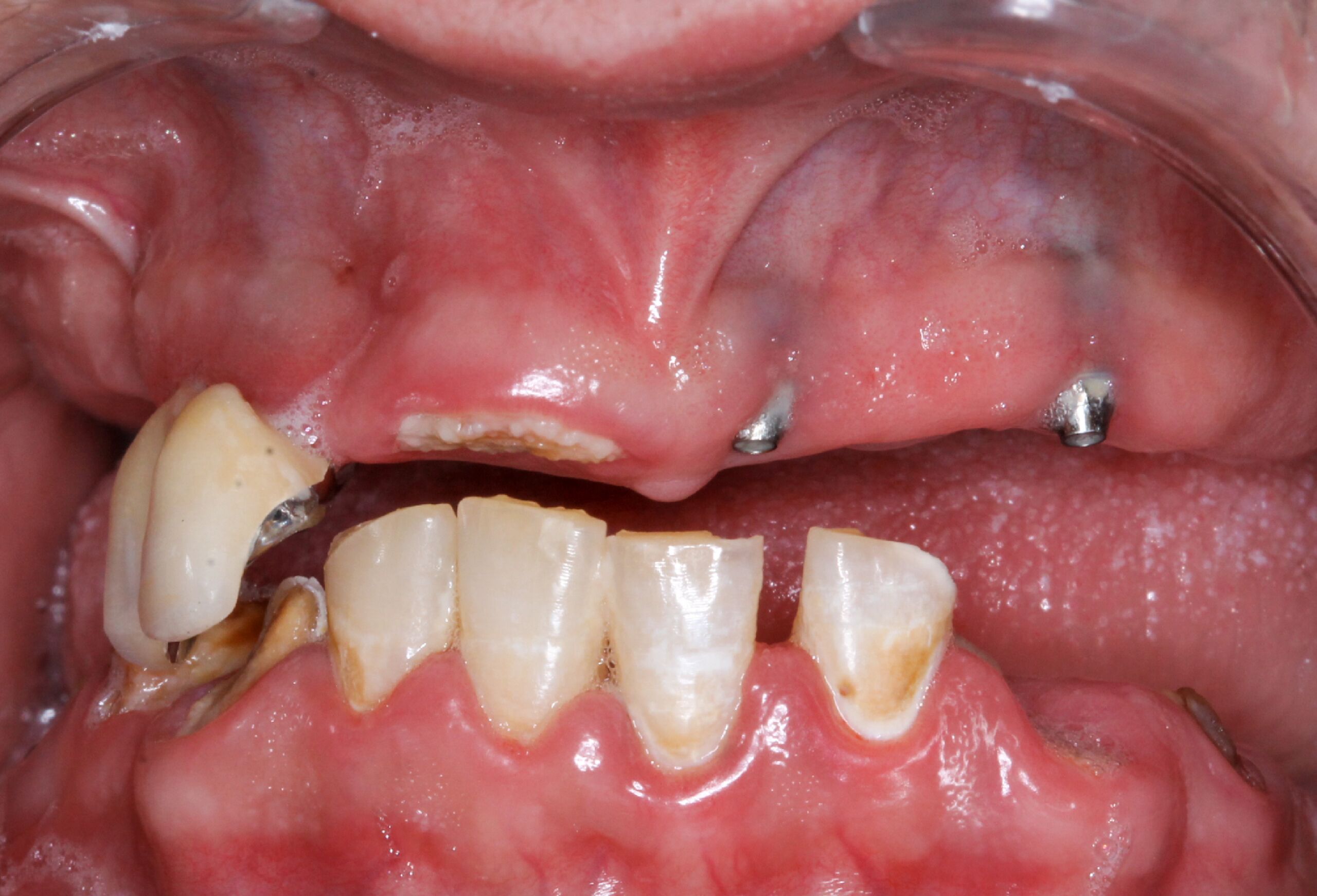 deep teeth cleaning cost uk