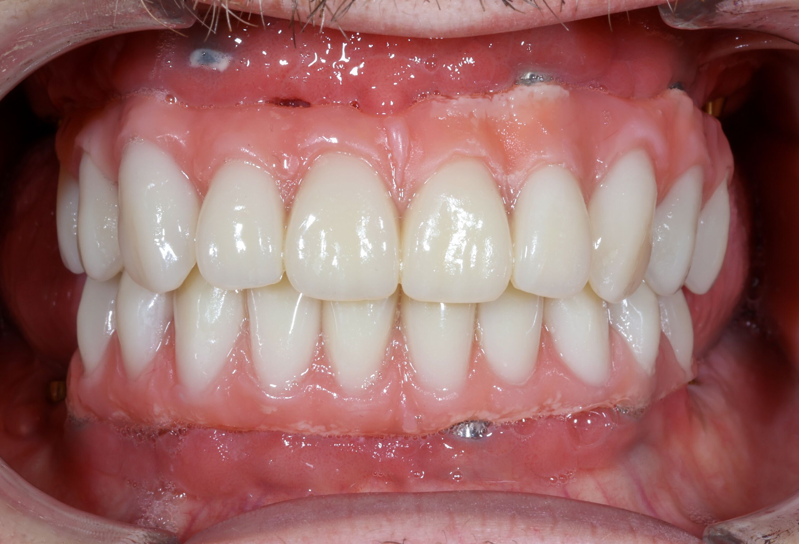 professional dental cleaning