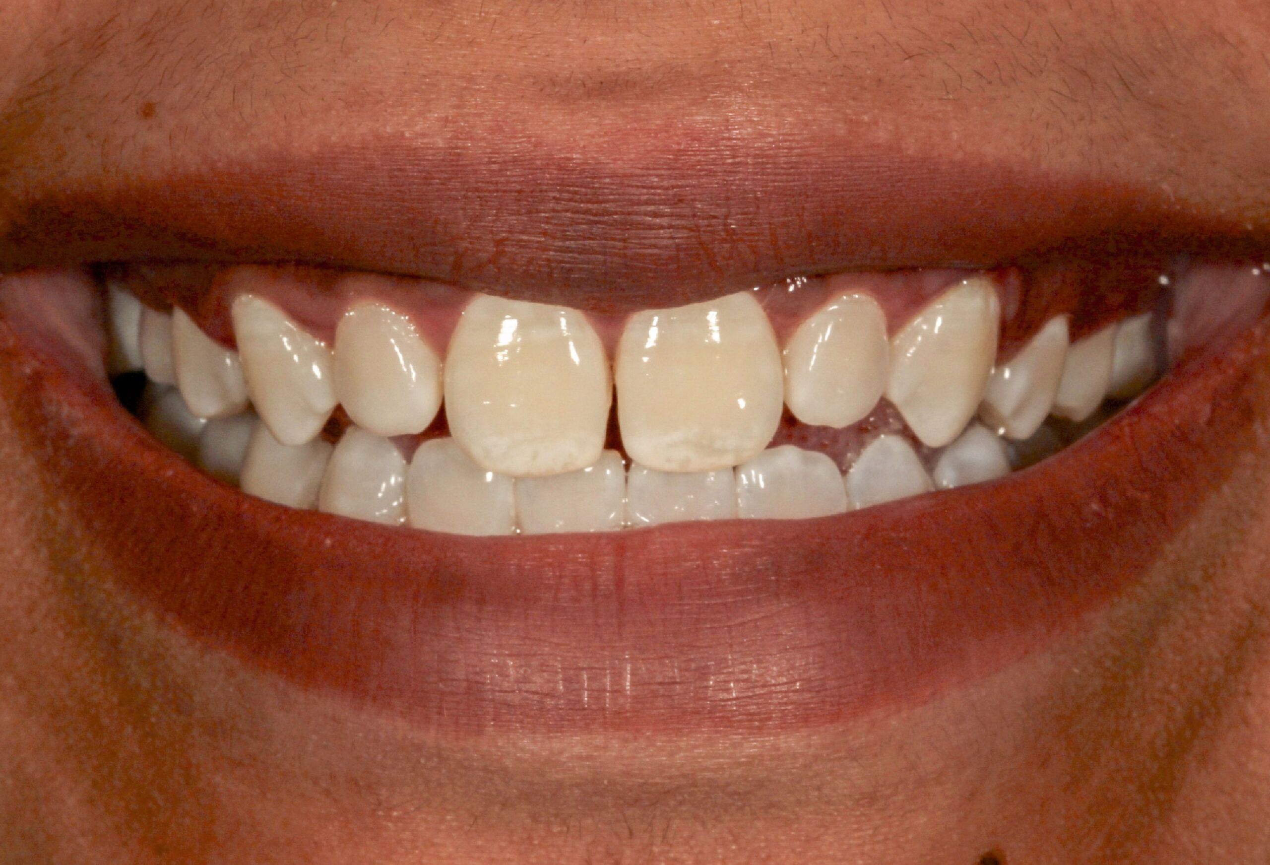emergency root canal treatment