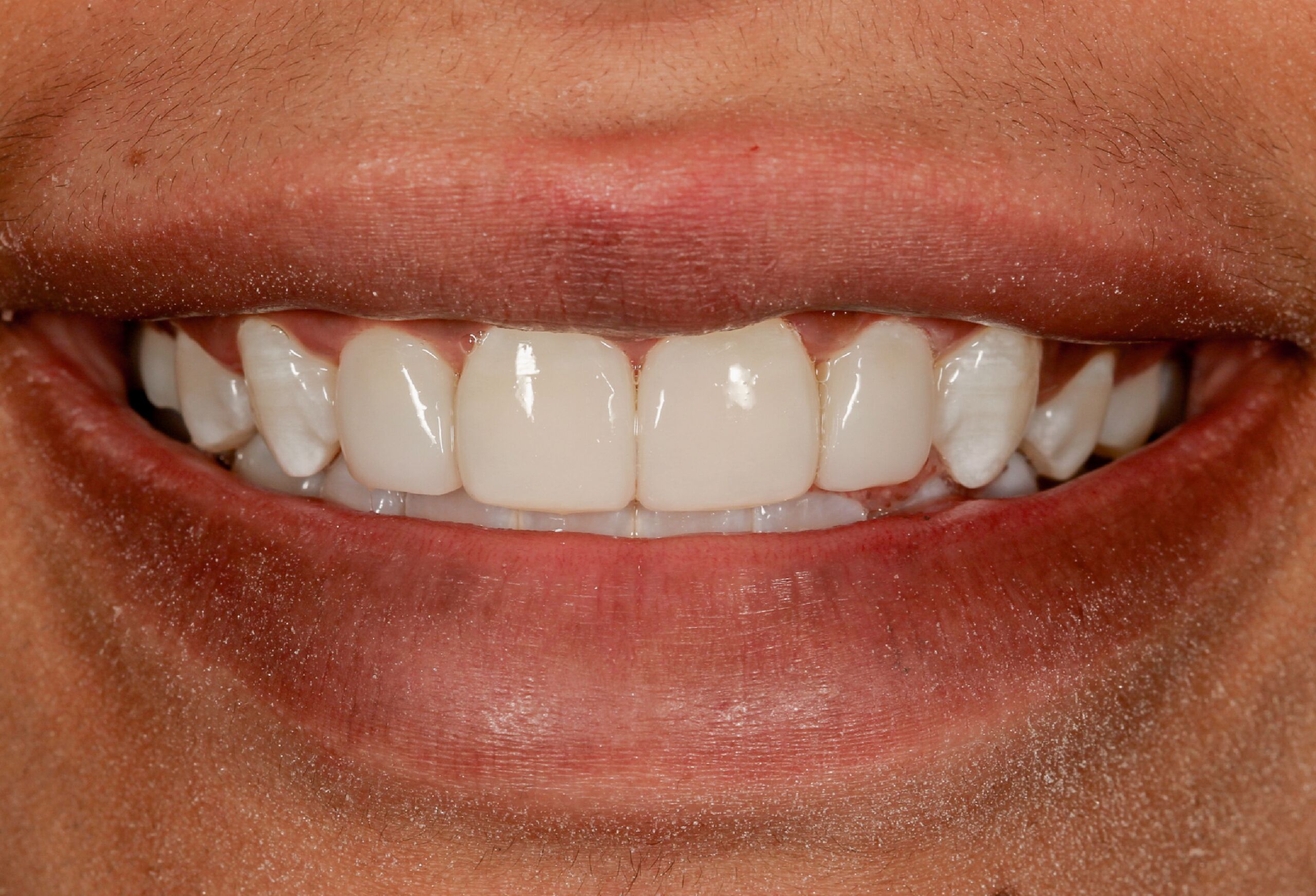 root canal infection treatment