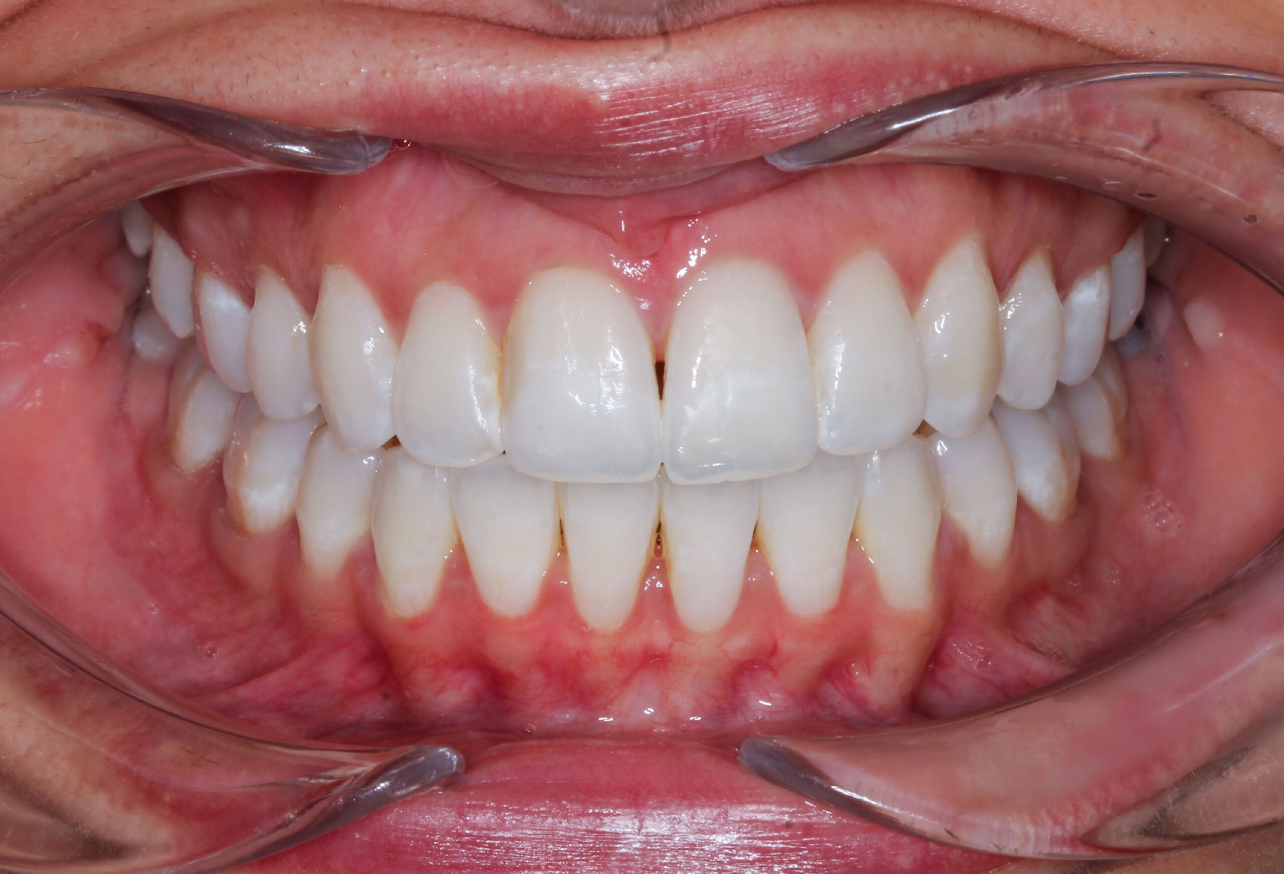 Smile Gallery 71 cocodental modern dental clinic providing professional care in uk