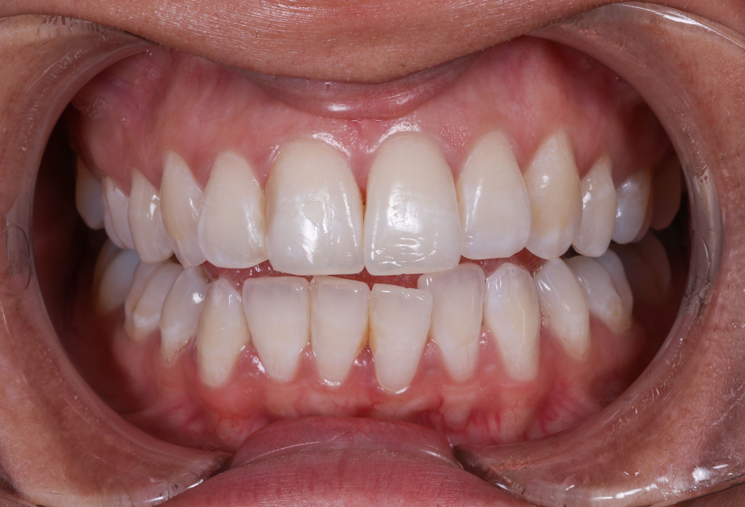 Smile Gallery 72 cocodental modern dental clinic providing professional care in uk