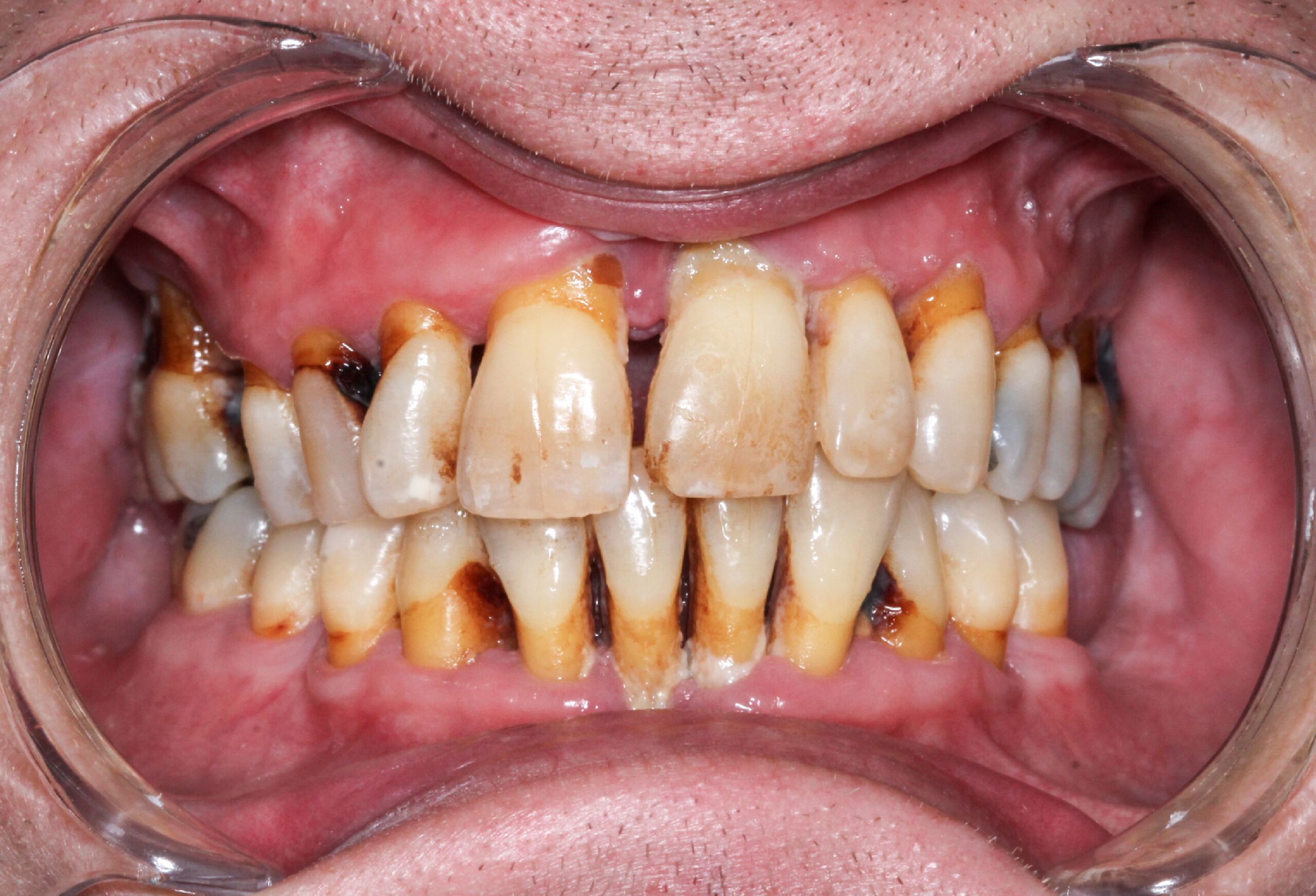 safe teeth whitening treatment