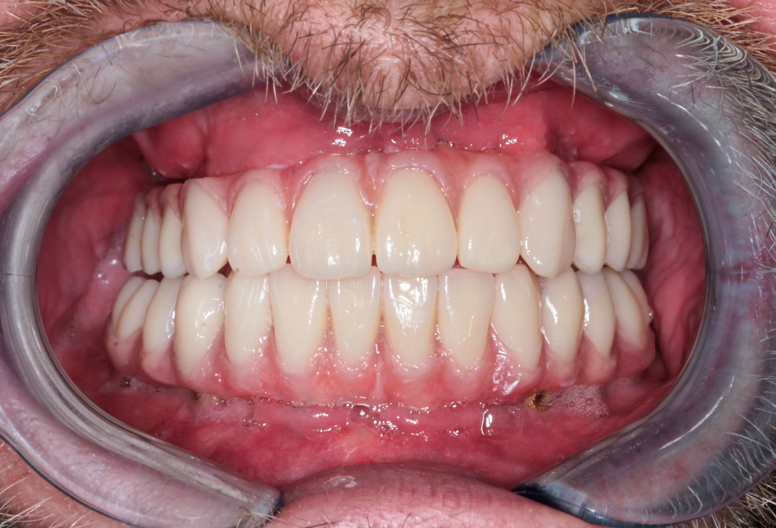 teeth whitening dentist near me