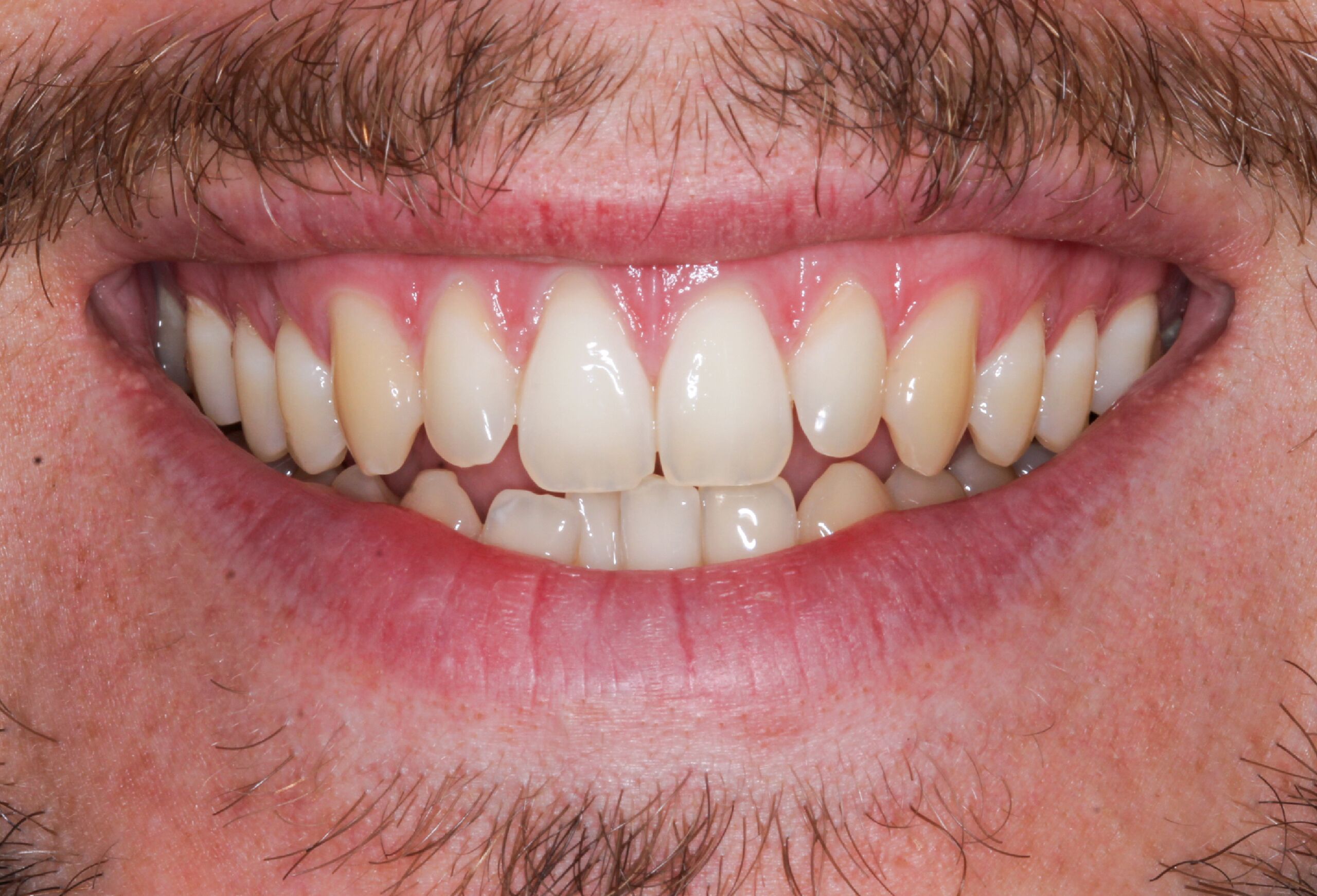 tooth nerve pain symptoms