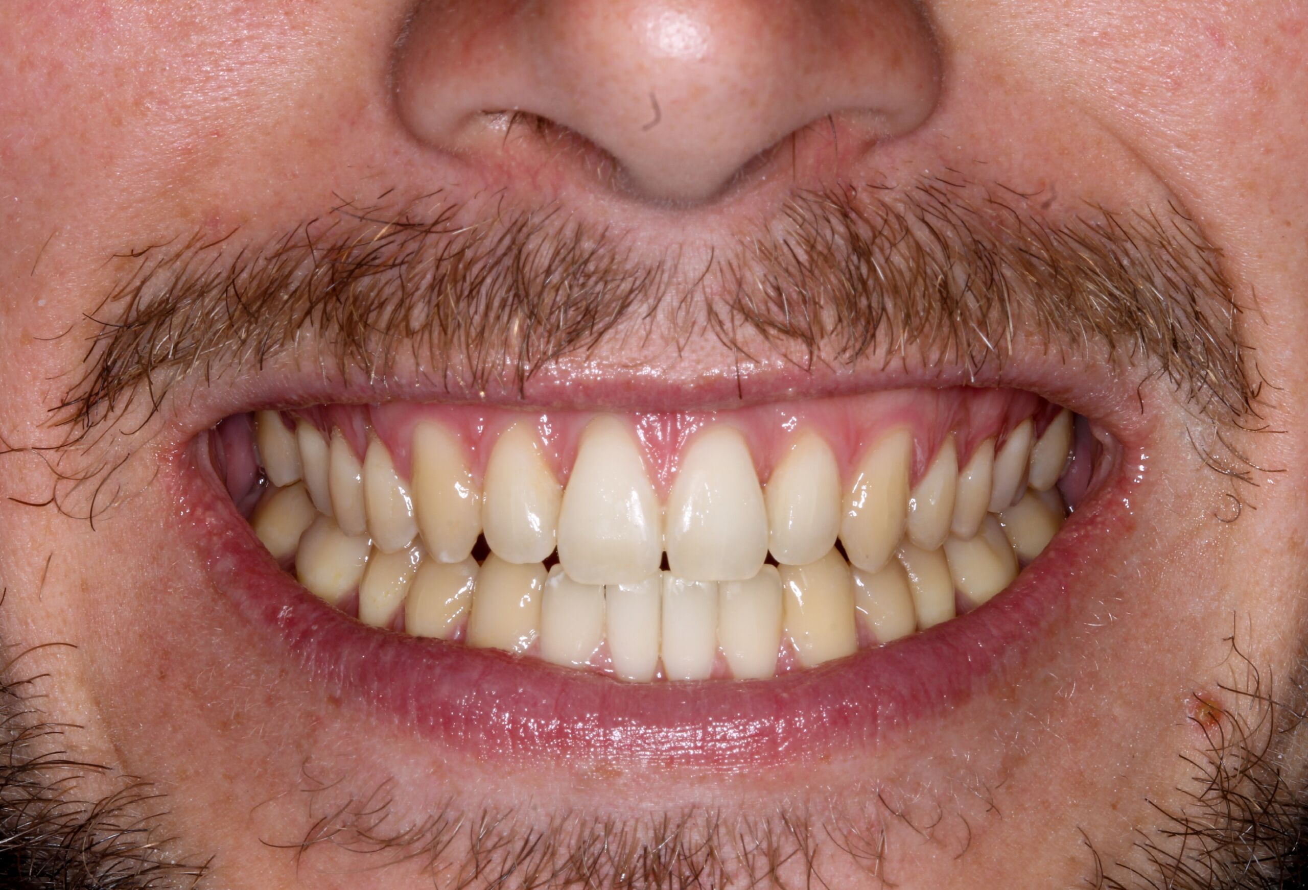 early symptoms of root canal infection