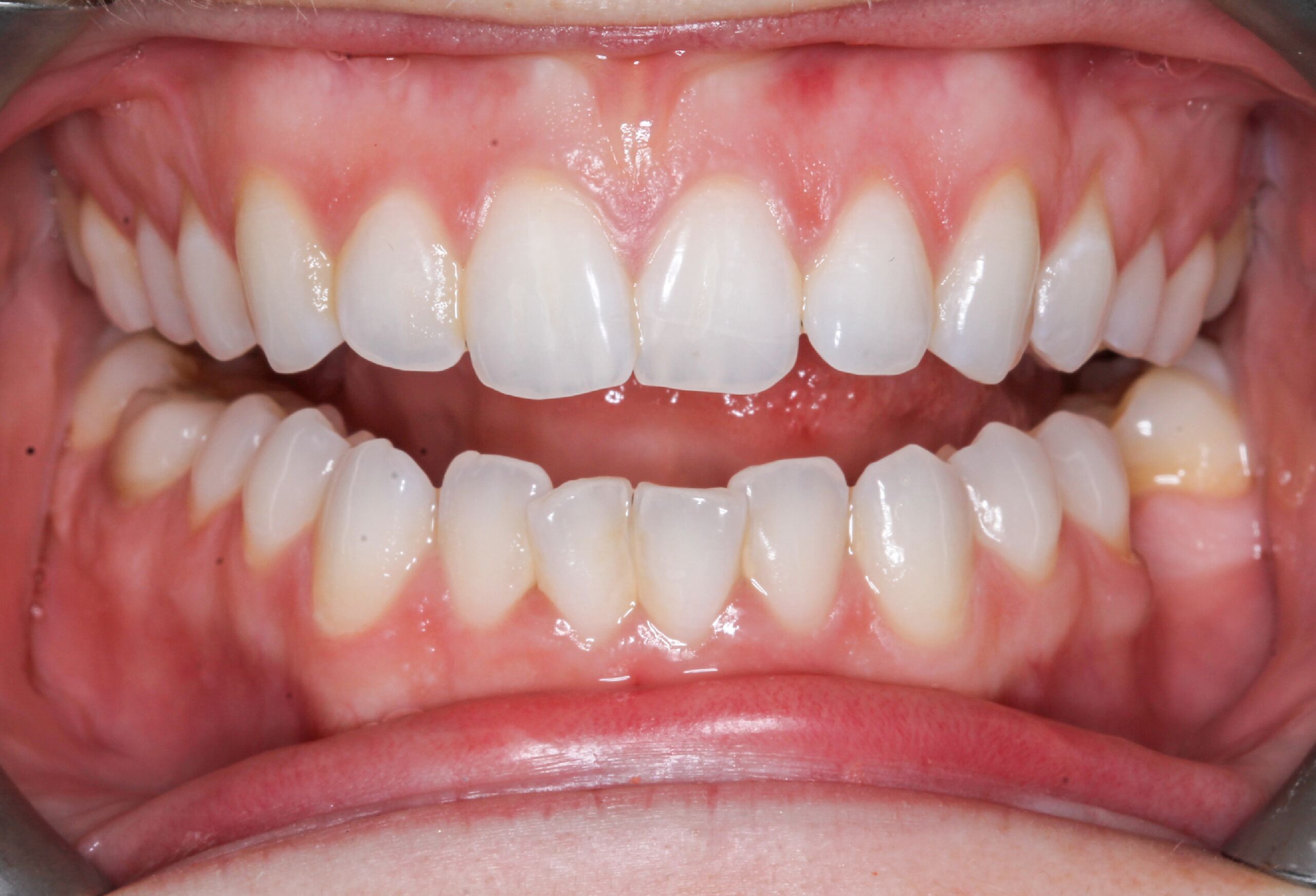signs you need a root canal