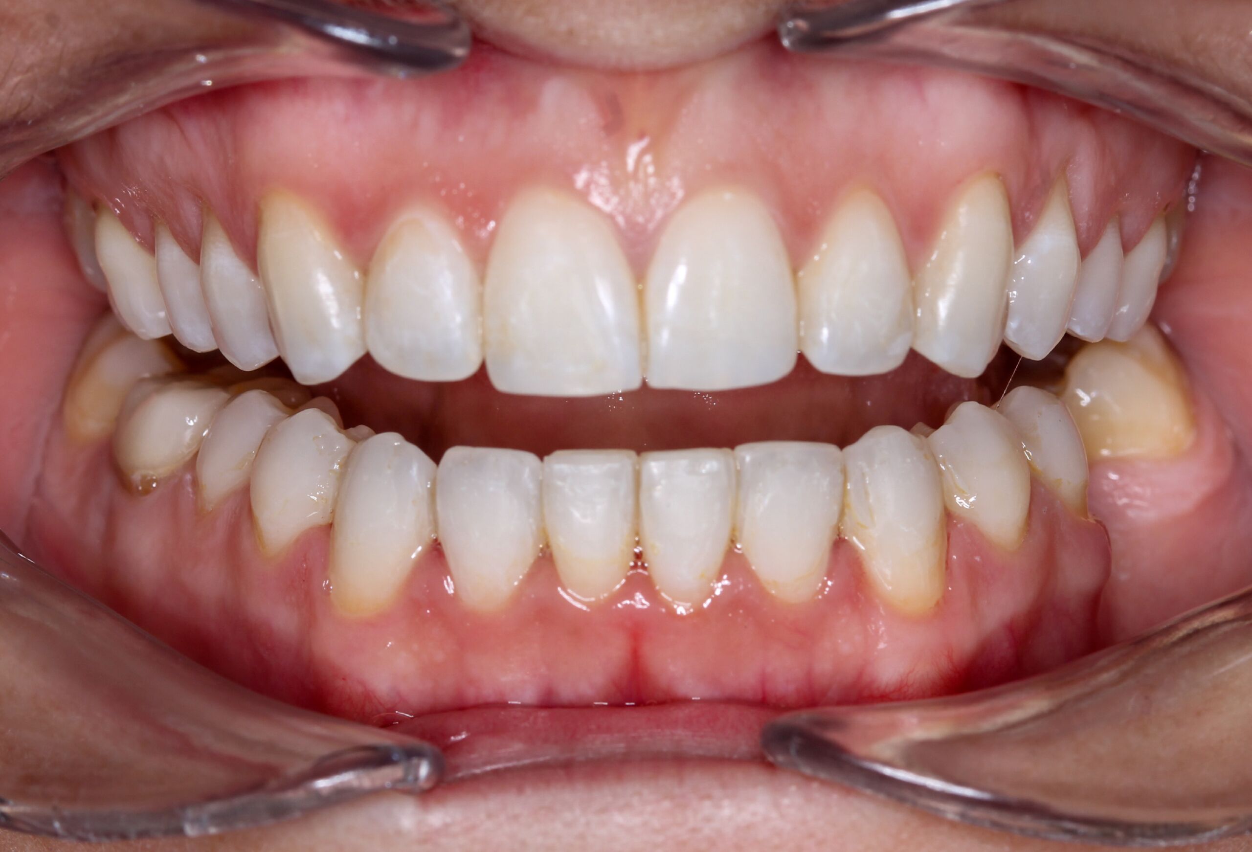 immediate load dental implants uk