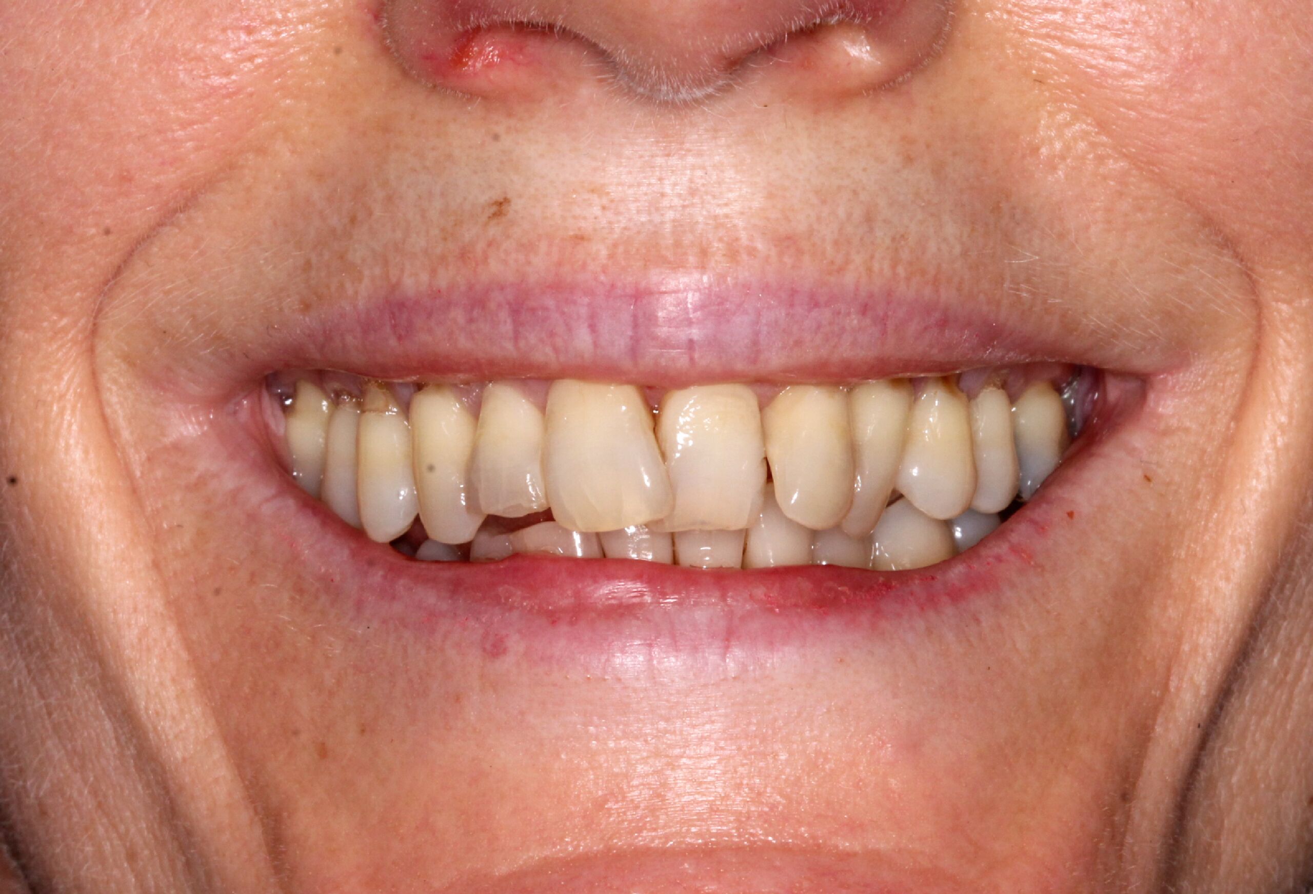 mini dental implants uk