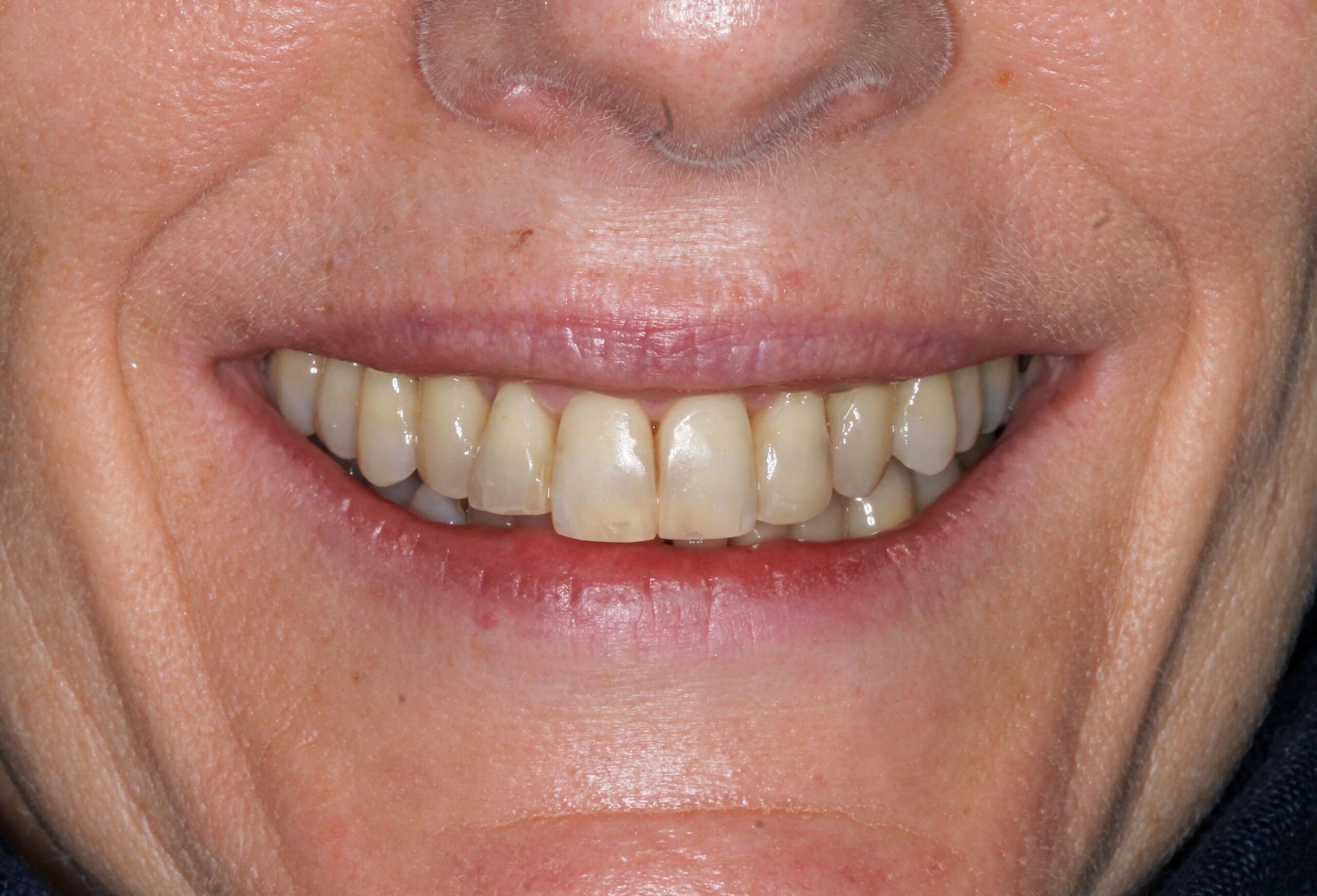 dental implants cost uk full mouth