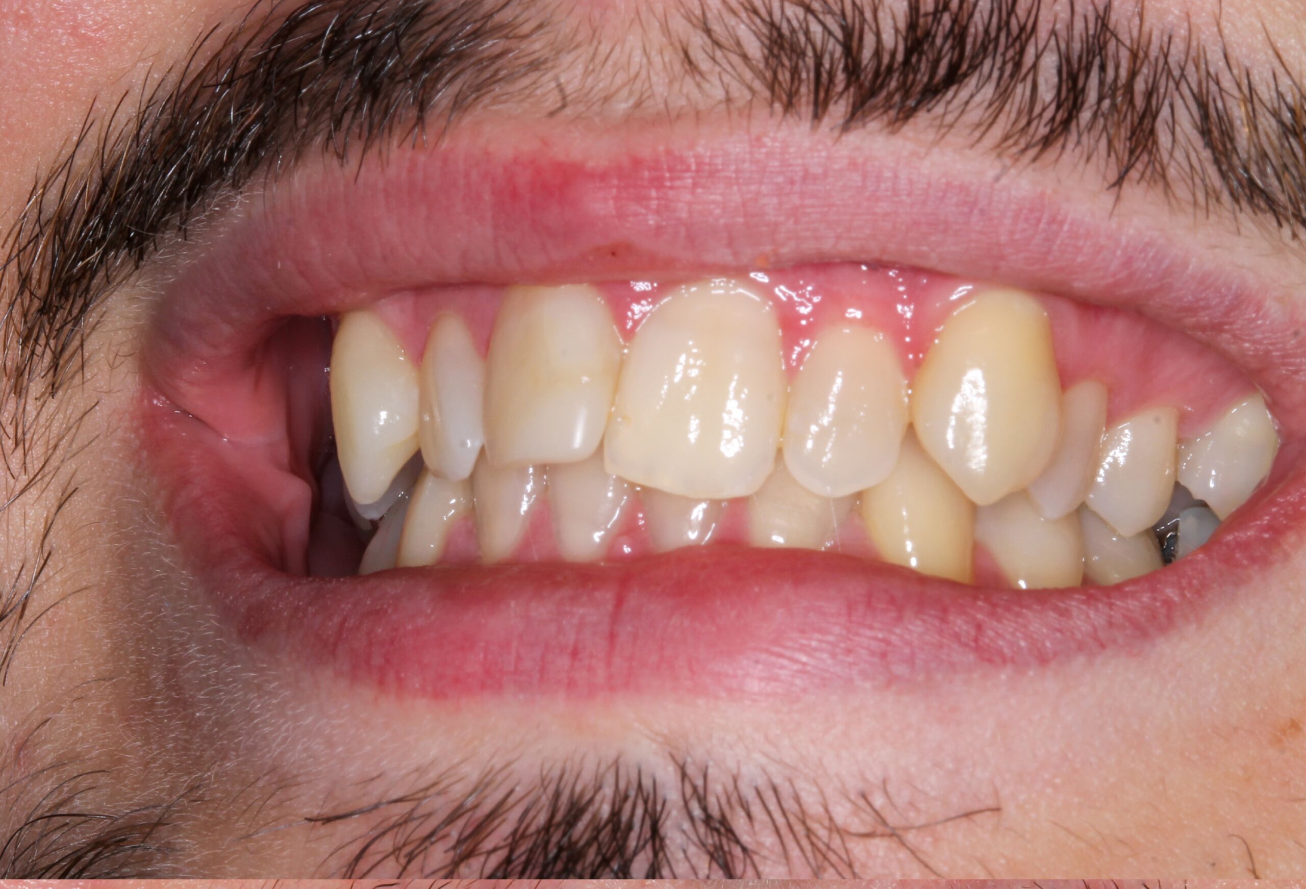 dental implants specialist uk