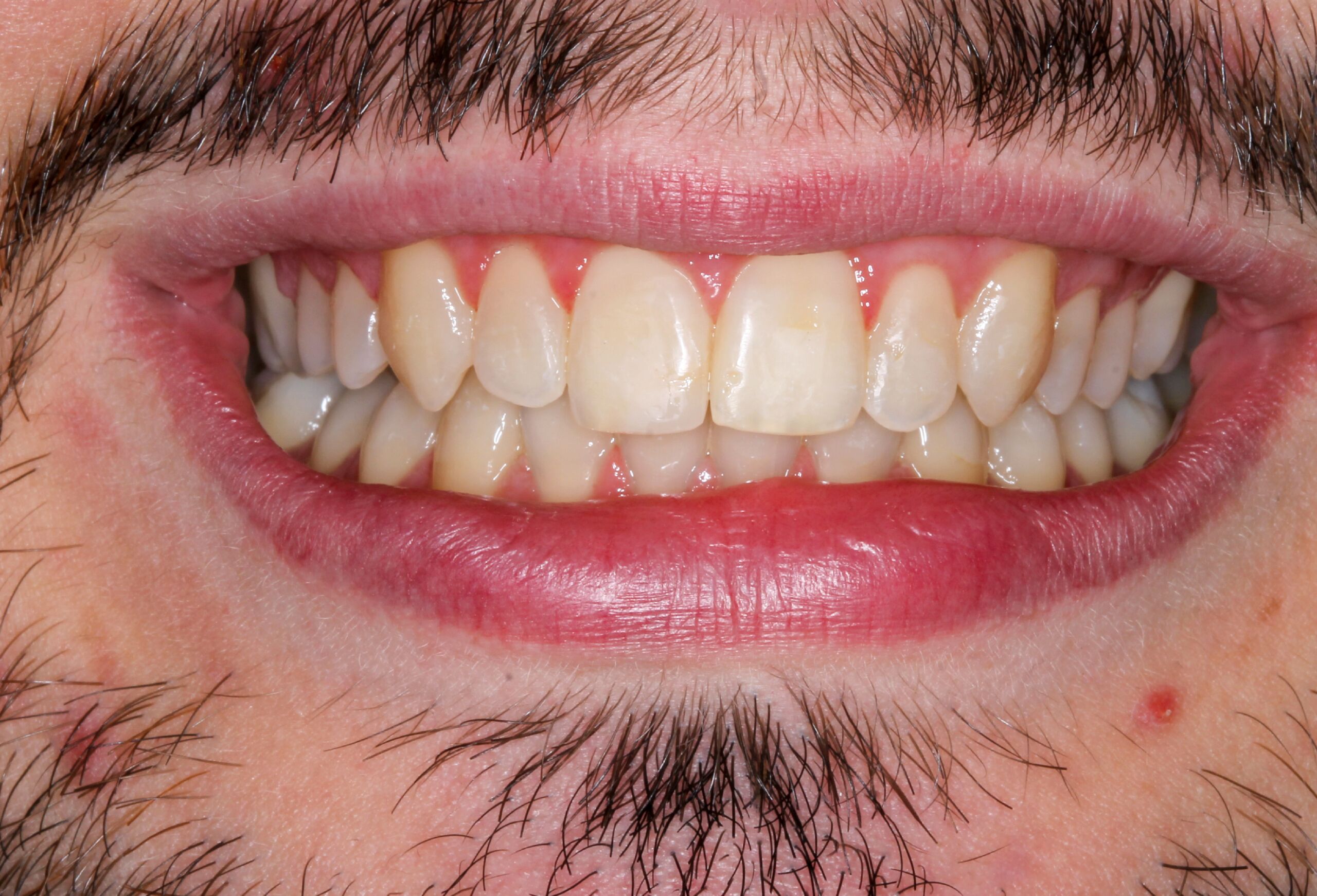 all on 4 dental implants near me