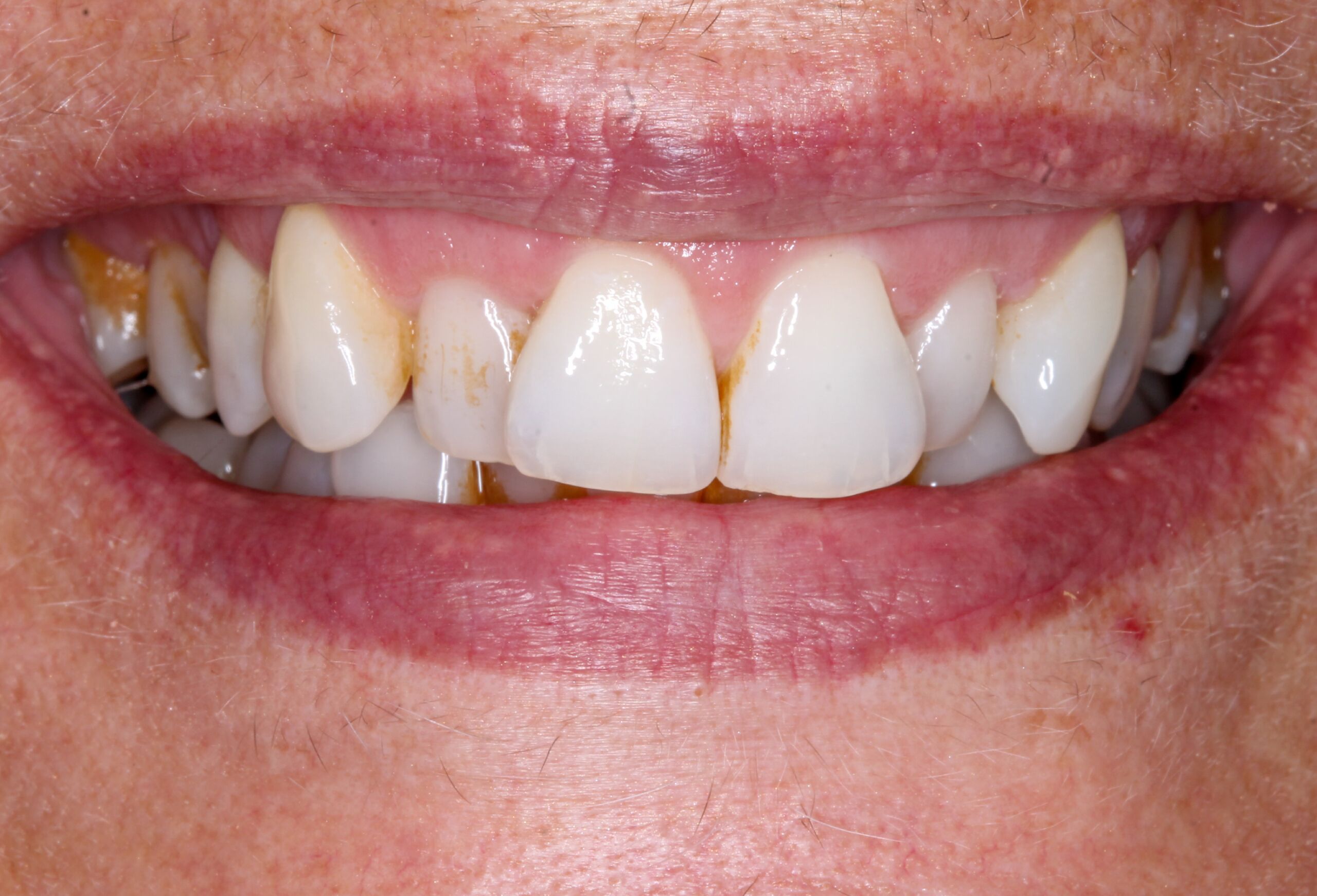 affordable all on 4 dental implants uk