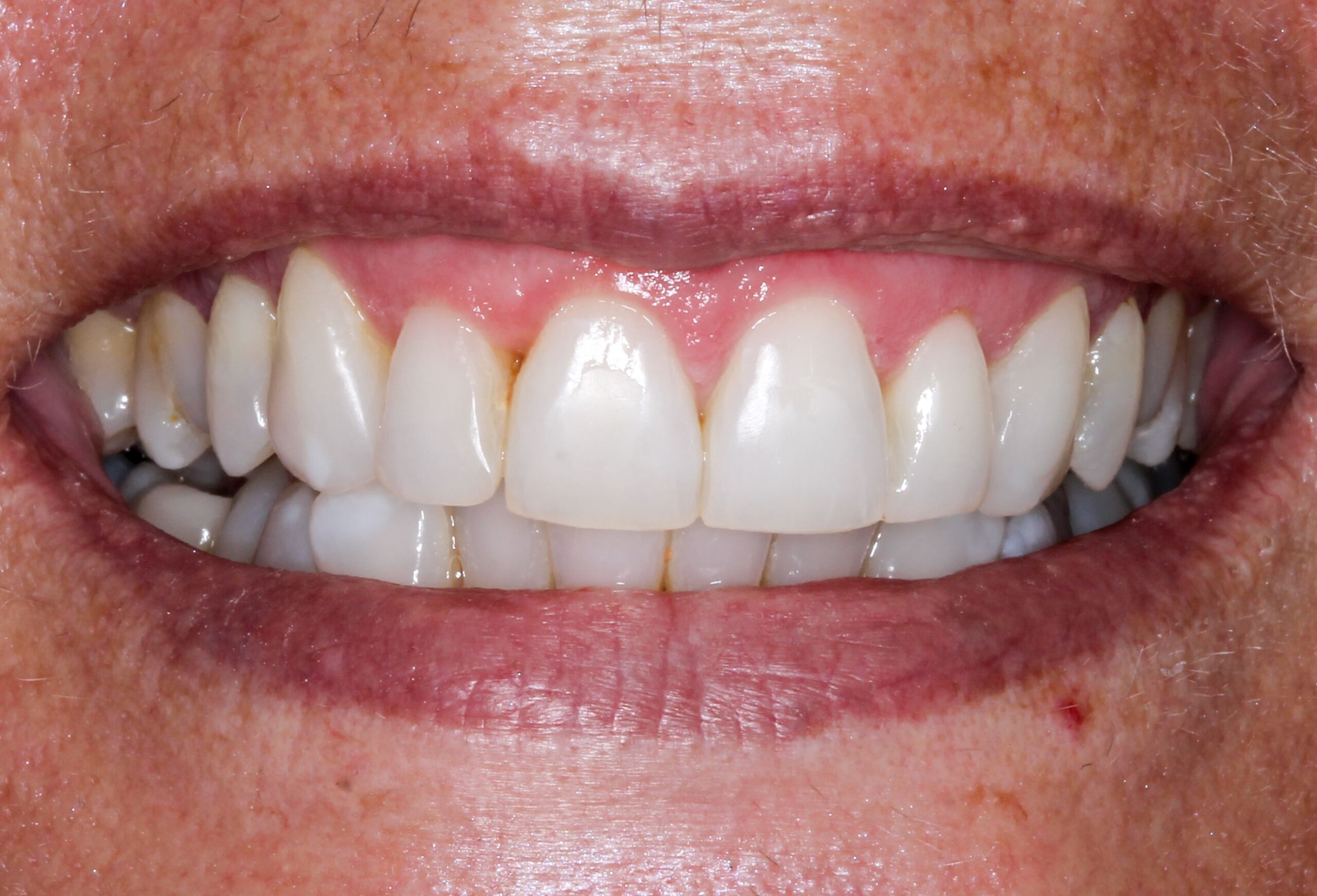 all on four dental implants uk price